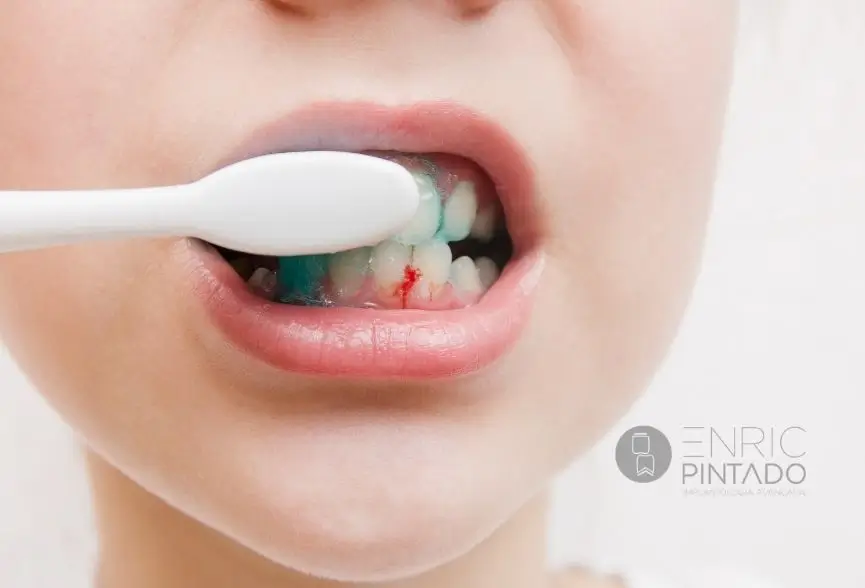 Encías que sangran al cepillar los dientes