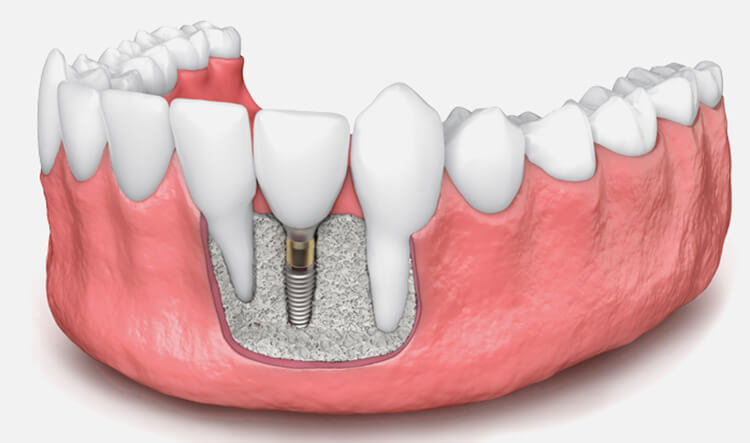clinica-dental-barcelona-y-manresa-regeneracion-osea-para-implantes
