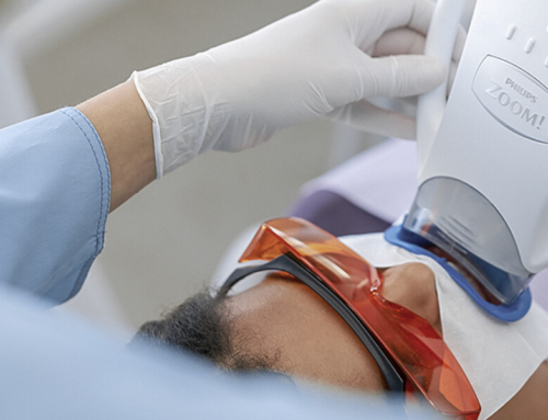 Tipos de blanqueamiento dental: cómo conseguir una sonrisa más blanca en Enric Pintado