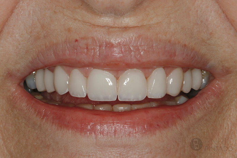 carillas-de-ceramica-caso-real-despues