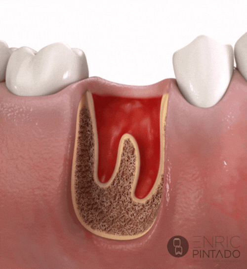 implantes-carga-inmediata-proceso Qué es un implante dental. Imagen de implante dental unitario.