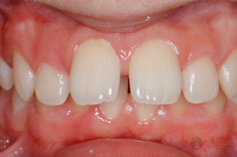 ortodoncia-caso-real-antes