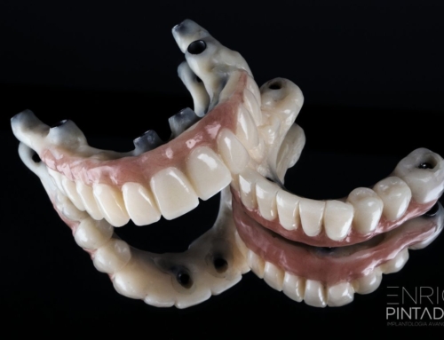 Implantes Dentales All-on-Four: qué son