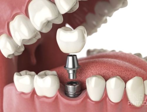 Coronas sobre Implantes Dentales