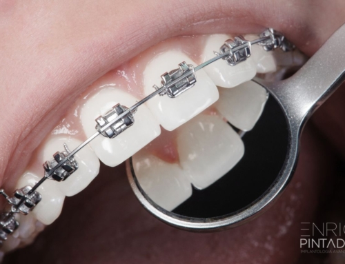 ¿Por qué es importante considerar la ortodoncia antes de colocar carillas dentales?