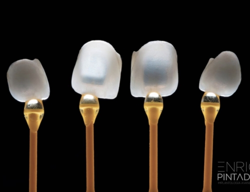 Carillas Artesanas: La Solución Perfecta para una Sonrisa Radiante