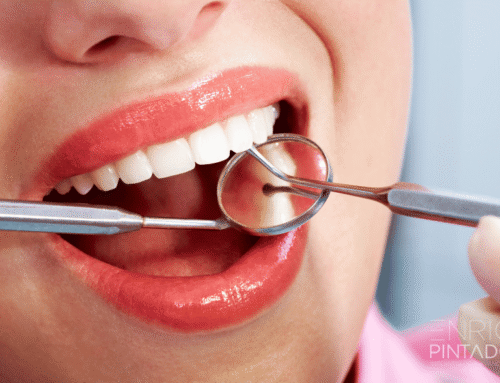 Fracturas dentales: causas, tipos y tratamientos