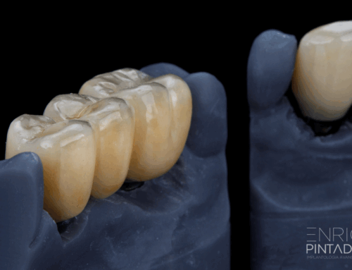 Coronas de Zirconio: La Revolución Estética y Funcional en Odontología