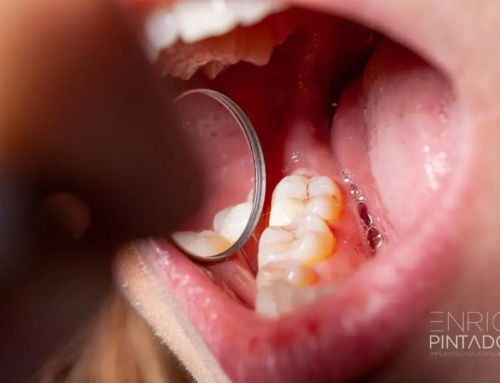 ¿Por qué falla un empaste o una corona dental? Causas, síntomas y soluciones