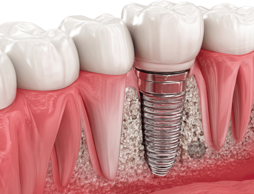 Implantes endoóseos: la solución definitiva para recuperar tu sonrisa en Barcelona y Manresa