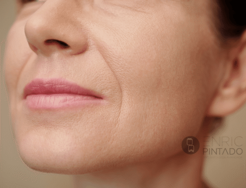Tratamiento del surco nasogeniano: cómo rejuvenecer el rostro de forma natural con medicina estética