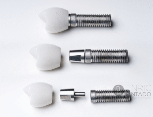 Implantes dentales en casos complejos: soluciones avanzadas para recuperar tu sonrisa